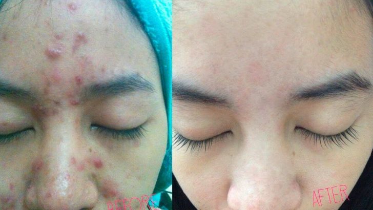 Cara Menghilangkan Jerawat & Parut Jerawat (Tips Doktor  